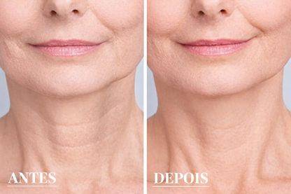 New Botox - Livre de Rugas e Linhas de Expressões