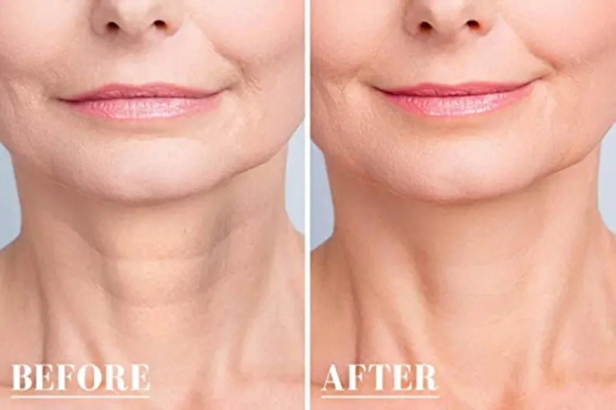 New Botox - Livre de Rugas e Linhas de Expressões