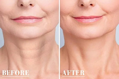 New Botox - Livre de Rugas e Linhas de Expressões