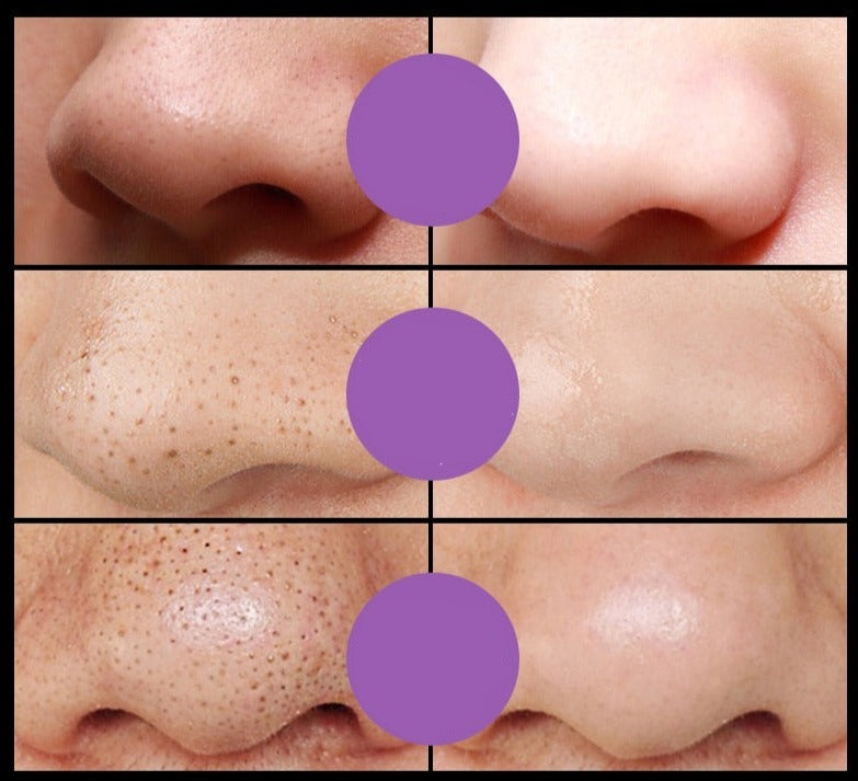 Removedor De Cravos Máscaras Faciais