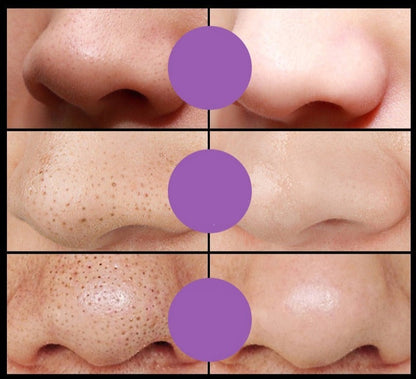 Removedor De Cravos Máscaras Faciais