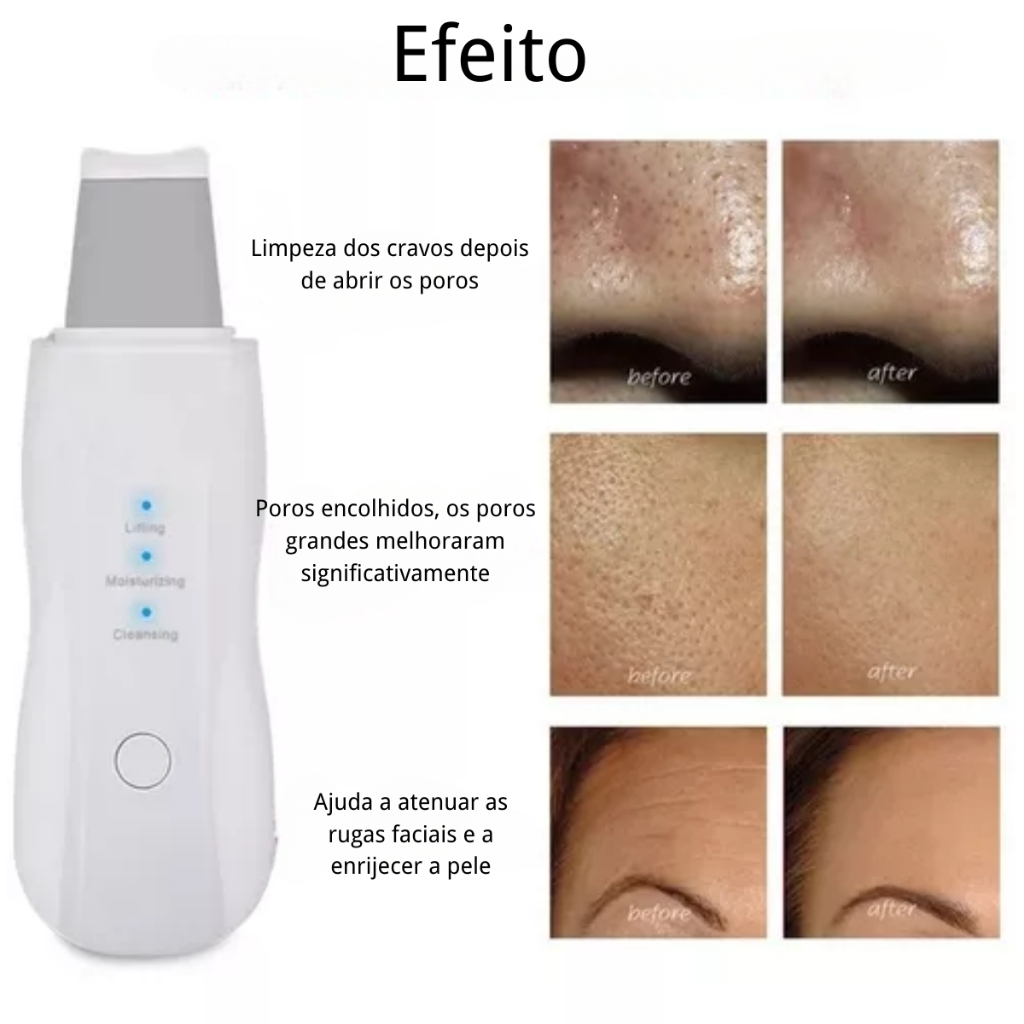 Aparelho de Peeling Esfoliante Ultrassônico Limpeza Facial Profunda Remoção de Cravos Antirrugas Sonic Skin