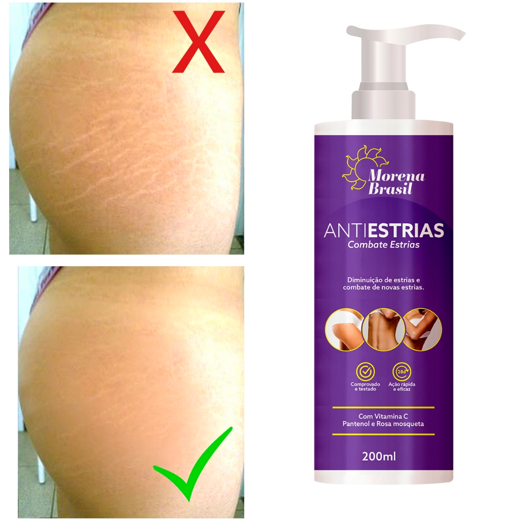 Creme Anti-Estrias - Diga Adeus às Estrias! Previne Novas Estrias & Reforça a Elasticidade Da Pele