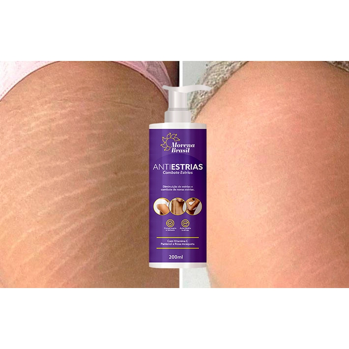 Creme Anti-Estrias - Diga Adeus às Estrias! Previne Novas Estrias & Reforça a Elasticidade Da Pele