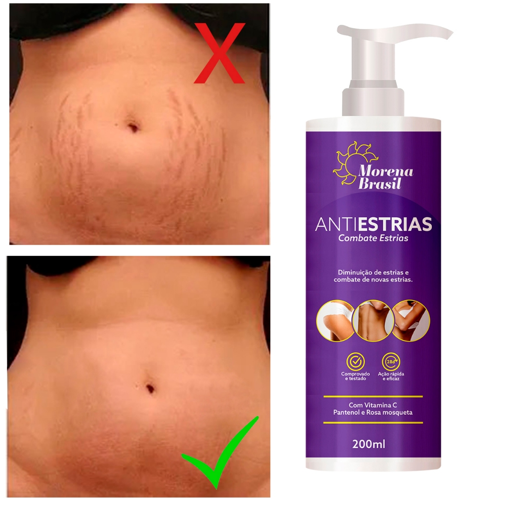 Creme Anti-Estrias - Diga Adeus às Estrias! Previne Novas Estrias & Reforça a Elasticidade Da Pele