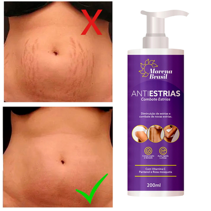 Creme Anti-Estrias - Diga Adeus às Estrias! Previne Novas Estrias & Reforça a Elasticidade Da Pele